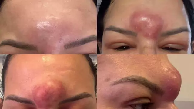 Evolução do edema no rosto de cliente de clínica estética (Foto: Reprodução dos autos de processo)