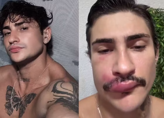 Willian Silva foi internado após desenvolver uma infecção na região do bigode - Foto: Redes sociais/Reprodução