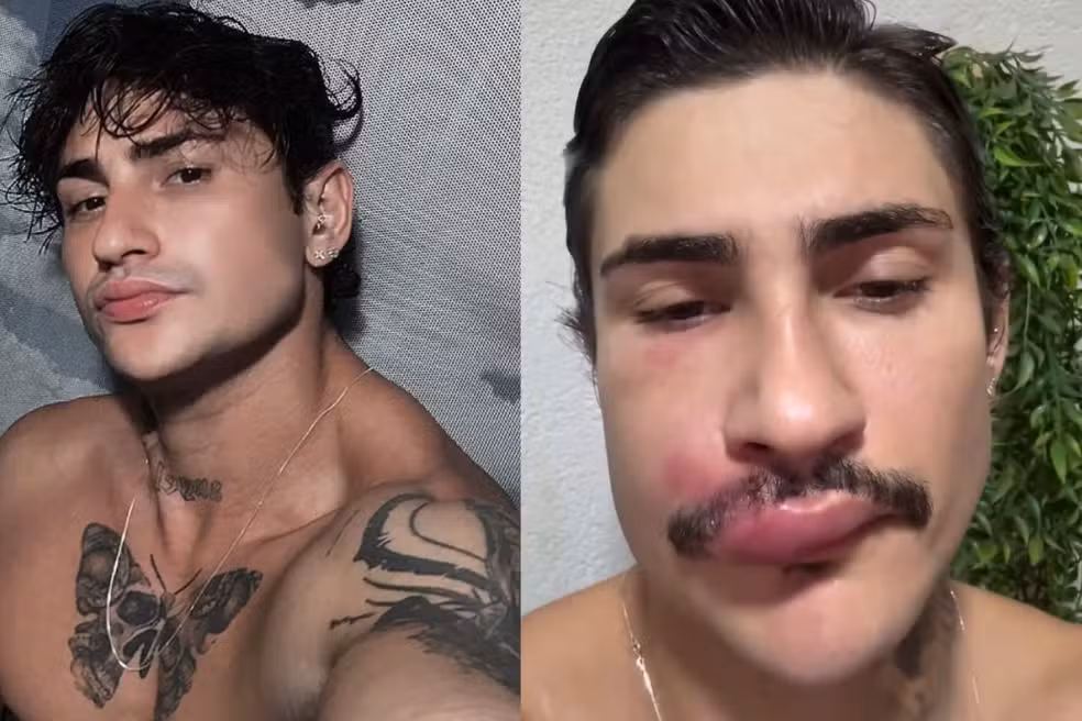 Influenciador de Campo Grande é internado após espremer espinha
