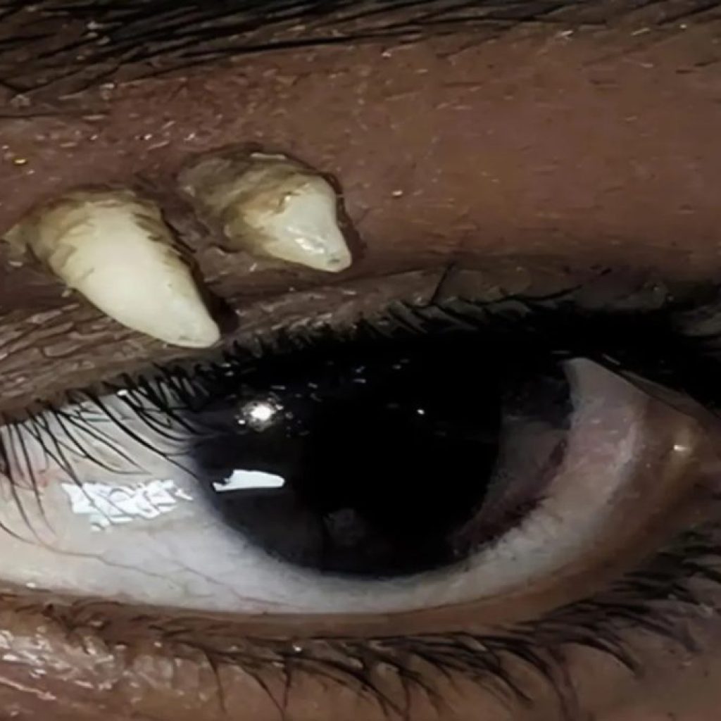 Adolescente na Índia descobre dente crescendo acima do olho; Entenda