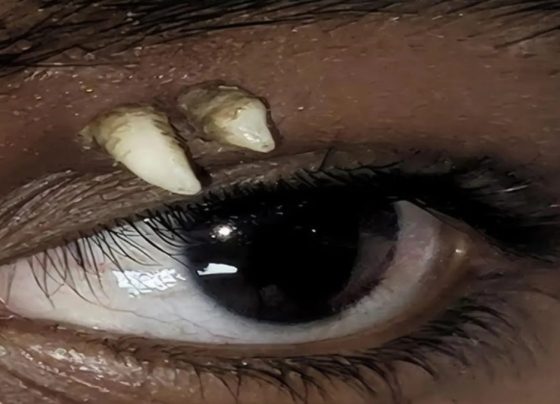 Adolescente na Índia descobre dente crescendo acima do olho; Entenda