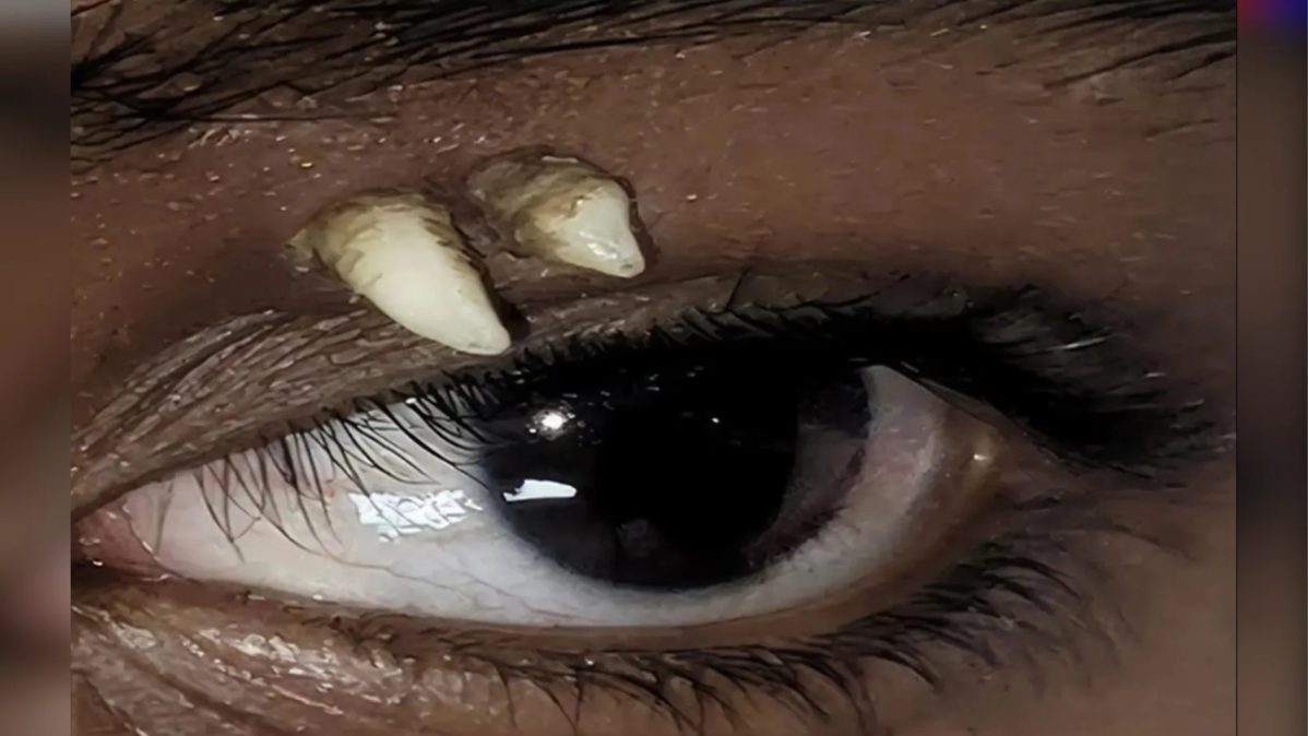 Adolescente indiano tem dente crescendo acima do olho em caso inédito