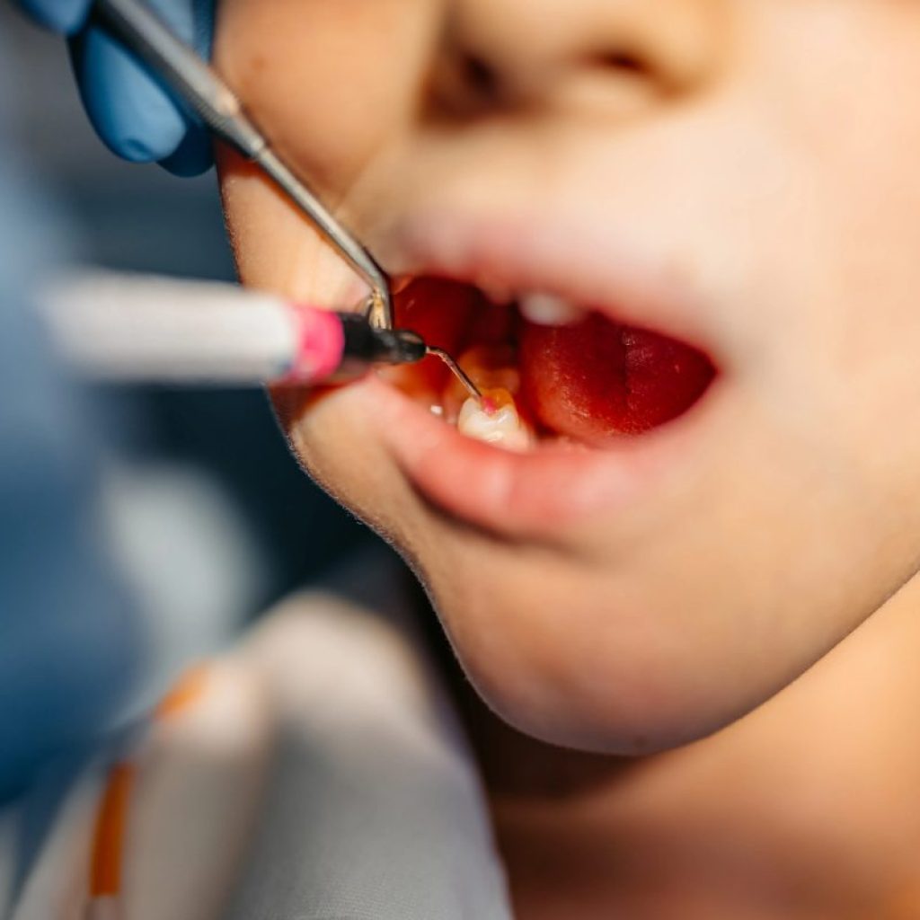 Crianças brasileiras vão ao dentista pela primeira vez só aos 7 anos, aponta levantamento