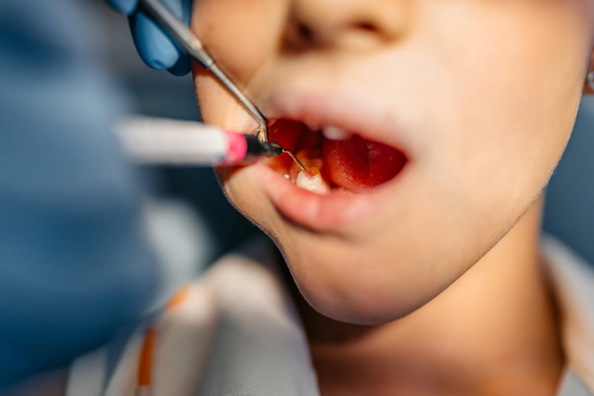 Crianças no Brasil vão ao dentista só aos 7 anos